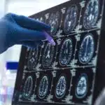 scientist analyzing alzheimer's and dementia brain